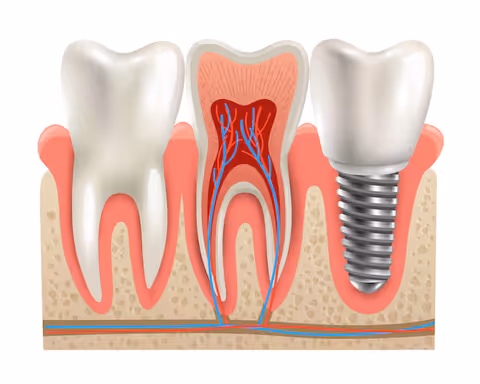 A Complete Guide to Dental Implants for Tooth Replacement